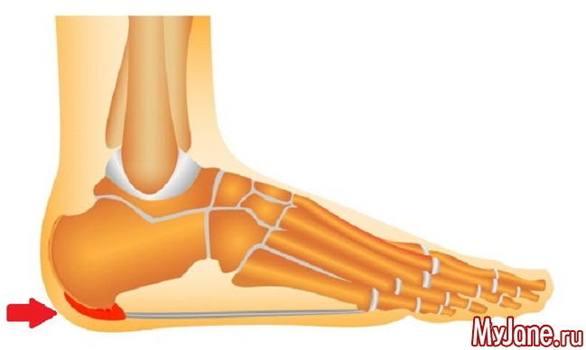 Пяточная Шпора Фото На Снимке Как Выглядит