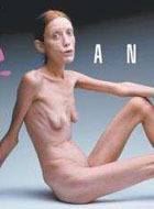 Страдавшая анорексией модель скончалась в возрасте 28 лет 