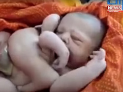 В Индии родился четырехрукий и четырехногий ребенок